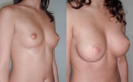 Breast enlargement 