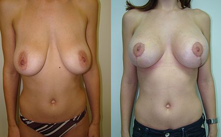 Breast reduction and breastlifting