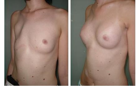 Korrektion der asymmetrie der brüsten
