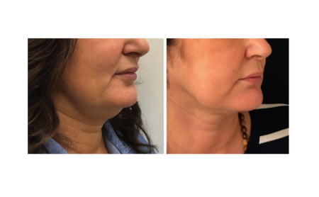NeckTite – liposuction of neck and upper arms