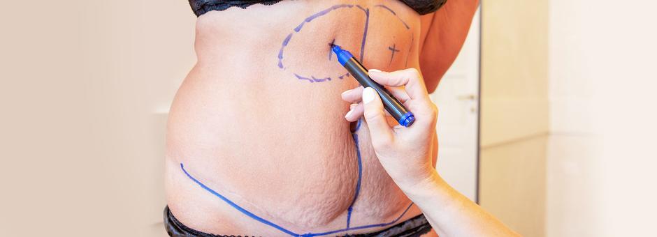Abdominoplastika ili liposukcija – koja procedura je za vas?