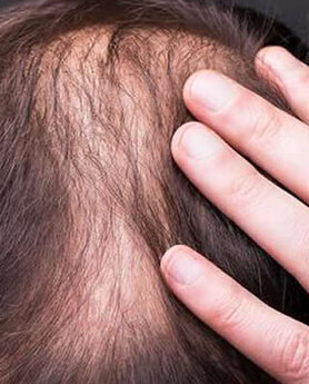 TRANSPLANTACIJA KOSE NIJE BAUK. EVO I ZAŠTO!