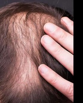 TRANSPLANTACIJA KOSE NIJE BAUK. EVO I ZAŠTO!