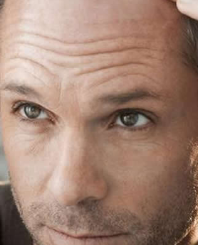 RECITE ZBOGOM ĆELAVOSTI – SIGURNA I EFIKASNA METODA PRESAĐIVANJA KOSE