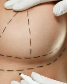 ŠTA JE POTREBNO DA ZNATE ZA NAJBRŽI OPORAVAK POSLE OPERACIJE DOJKE