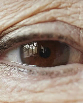 BLEFAROPLASTIKA – VRATITE STARI SJAJ VAŠIM OČIMA!