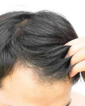 ARE YOU A GOOD CANDIDATE FOR HAIR TRANSPLANTATION?