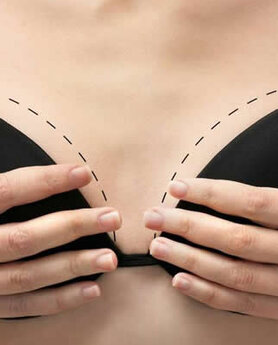 POVEĆANJE I PODIZANJE GRUDI – SVE ŠTO STE ŽELELI DA ZNATE