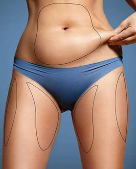 ESTETSKA HIRURGIJA – SKIDANJE SALA SA STOMAKA LIPOSUKCIJOM