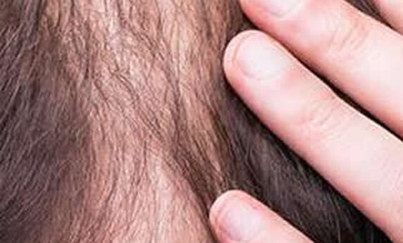 HAIR TRANSPLANT IS NOT A FRIGHTENING EXPERIENCE. HERE'S WHY!