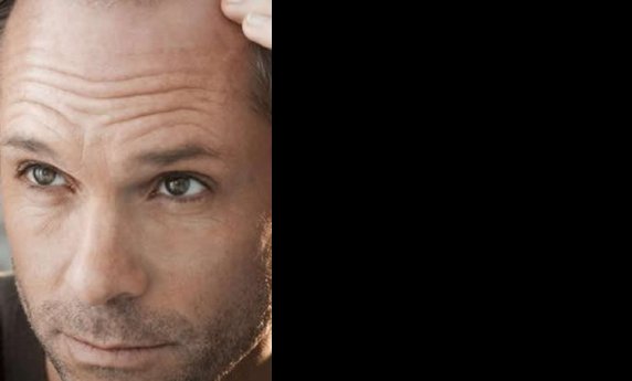 RECITE ZBOGOM ĆELAVOSTI – SIGURNA I EFIKASNA METODA PRESAĐIVANJA KOSE