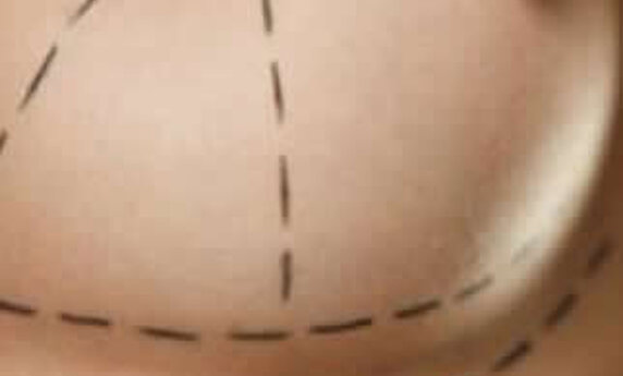 WHAT YOU NEED TO KNOW FOR THE FASTEST RECOVERY AFTER BREAST SURGERY