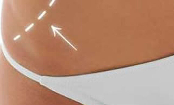 QUICK AND EASY WAY TO A FIRM AND SCULPTED BODY - TOTAL BODY LIFTING