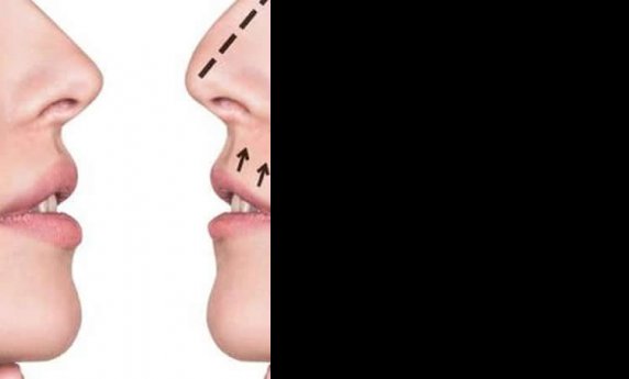 OPERACIJA NOSA - SVE ŠTO STE ŽELELI DA ZNATE