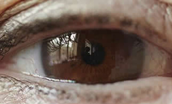 BLEPHAROPLASTY - RESTORE THE FORMER SPLENDOR TO YOUR EYES!