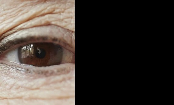 BLEFAROPLASTIKA – VRATITE STARI SJAJ VAŠIM OČIMA!