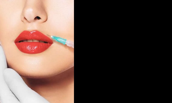 HIJALURONSKI FILERI – SVE ŠTO JE POTREBNO DA ZNAŠ!