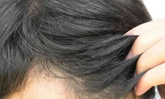 DA LI STE DOBAR KANDIDAT ZA TRANSPLANTACIJU KOSE?