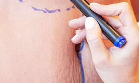 ABDOMINOPLASTY OR LIPOSUCTION – WHICH PROCEDURE IS FOR YOU?