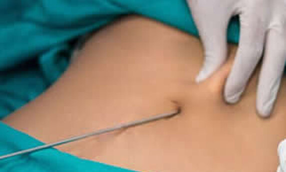 IF YOU'RE CONSIDERING LIPOSUCTION, HERE'S WHAT YOU NEED TO KNOW!