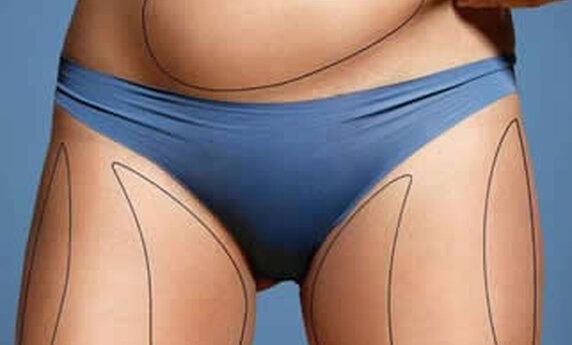 AESTHETIC SURGERY – REMOVING BELLY FAT WITH LIPOSUCTION