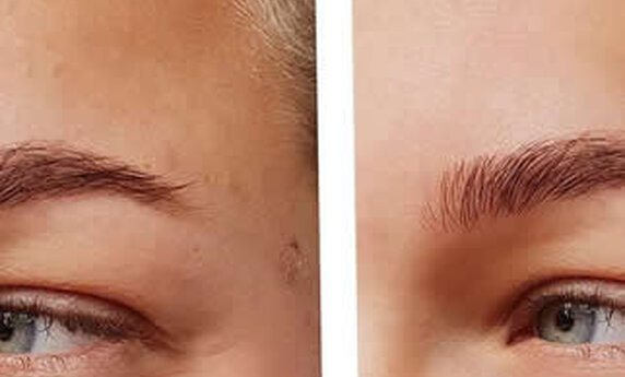 DROOPY EYELIDS – A QUICK AND EASY SOLUTION 